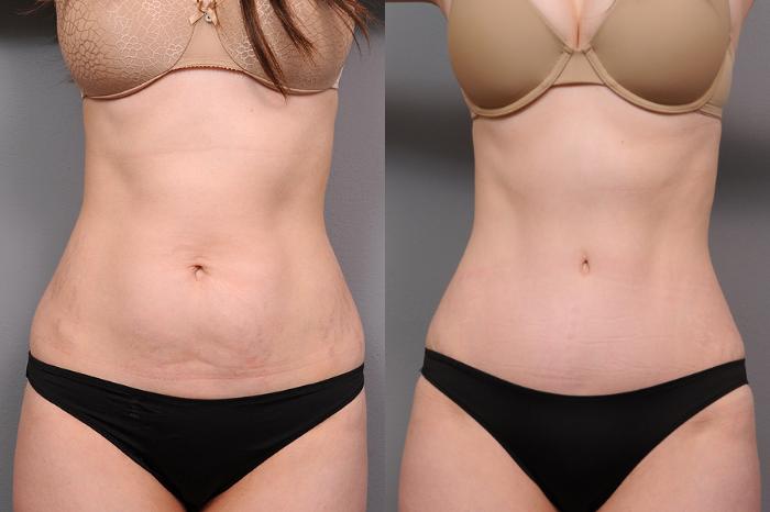 RICIAL 7 - in - 1 Red Light Therapy Belt before and after use