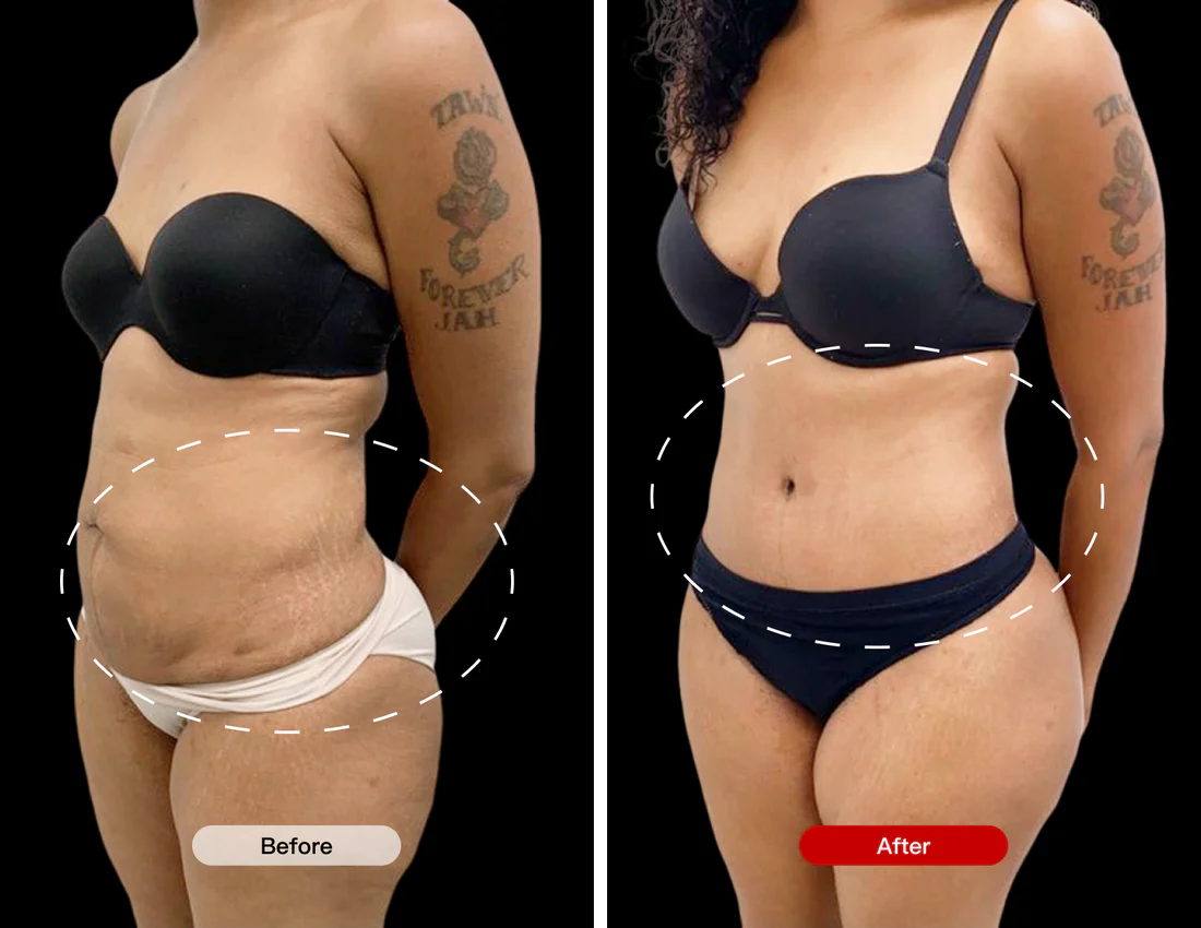 Before and After Using the Red Light Therapy Belt