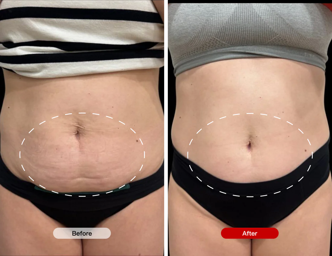 Before and After Using the Red Light Therapy Belt